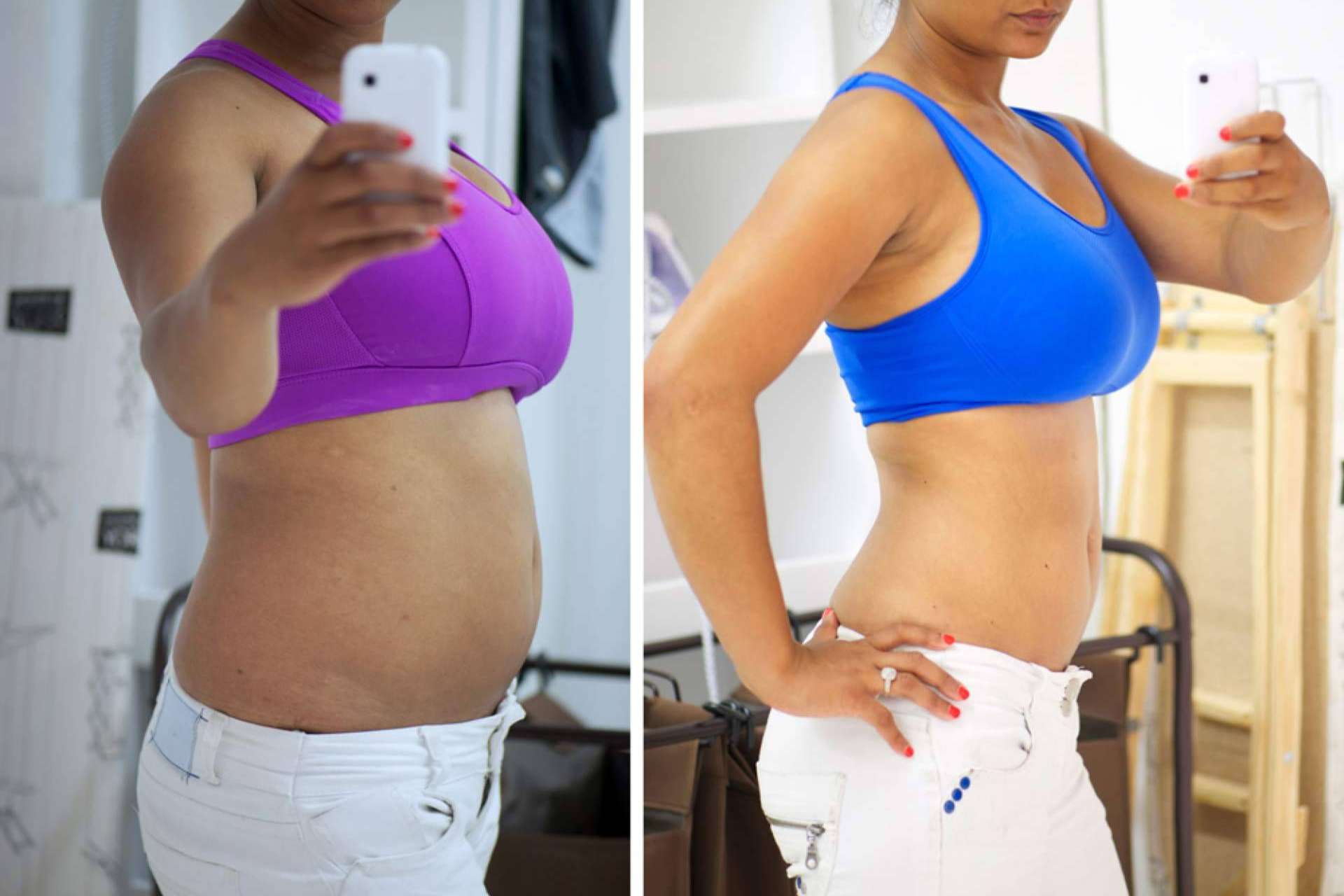 Miami’s Best BBL Surgeons; Transform the Silhouette at Dolls Plastic Surgery